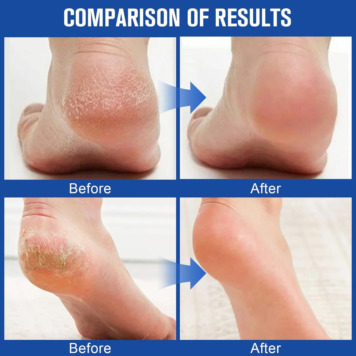 60% Urea Foot Cream
